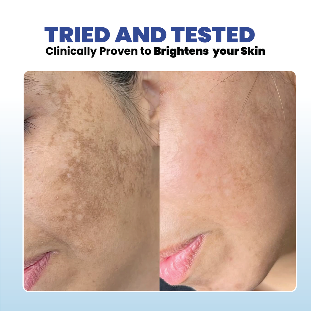 l glutathione acne scars Capsules - 1,500mcg L-Glutathione Supplement with Vitamin C - Skin Tone Enhancer - Targets Dark Spots & Marks - Antioxidant Supplement for Beauty & Health Support Glutathione oral liquid Drinkable 15